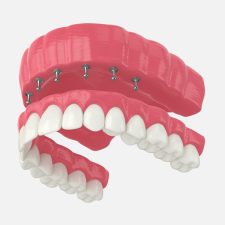 Implant-supported Dentures 101: Everything You Need to Know