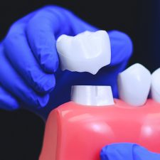 How Can Dental Crowns Protect Your Teeth?