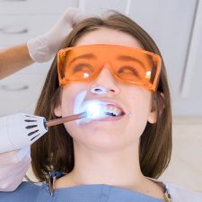 What to Expect After Dental Bonding: Step-by-Step Guide