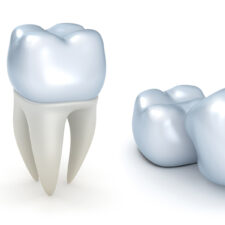 How do Dental Crowns Shield Your Teeth from Further Damage?