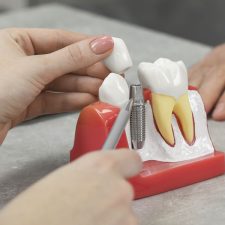Dental Implant Aftercare: Tips for Faster Healing