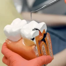 Common Symptoms of an Infected Tooth Requiring Root Canal